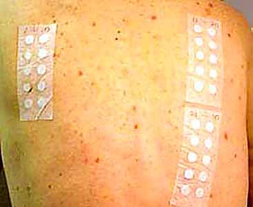 example of patch test allergen tapes  being applied to patient;s back