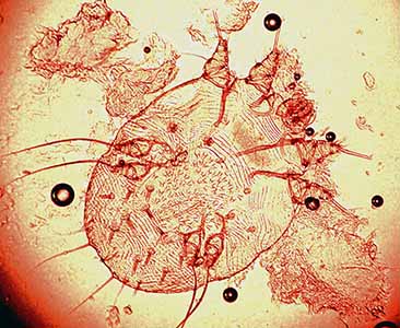 microscope image of a scabies mite,